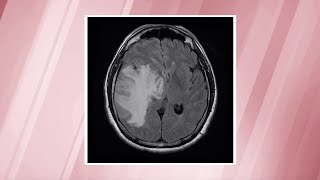 Glioblastoma—the most commonlydiagnosed brain cancer  OSUCCC – James [upl. by Amir]