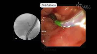 ERCP Procedure Video  Best Gastroenterologist in Bangalore  Dr Dinesh Kini  Sakra World Hospital [upl. by Adnilim]