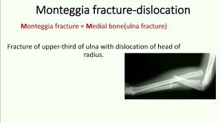 Monteggia fracture dislocation [upl. by Adym956]