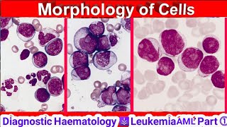 Hematology ⚶ Leukemia AML Morphology HD [upl. by Yatnuhs]