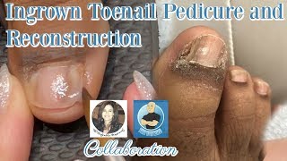 Pedicure with Toenail Reconstruction After Ingrown Toenail Removal with The Toe Bro [upl. by Naida54]