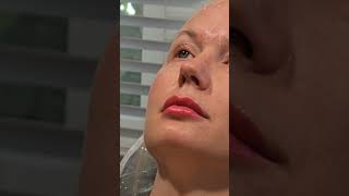 Botox microtoxin injections for undereyes 5 units each side botox aesthetics botoxtraining [upl. by Zerline]