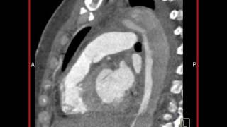 Cardiac Aortic dissection with compression of the true lumen by false lumen 3 of 4 [upl. by Soilissav]