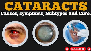 5 Surprising Causes and Treatments for Cataracts Revealed [upl. by Isej]