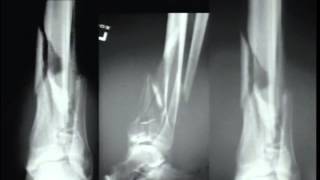 Pilon Fractures Management Options [upl. by Elreath168]