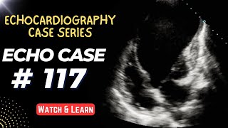 ECHO CASE 117  Echocardiography For Beginners  Echocardiogram Cases [upl. by Einiffit703]