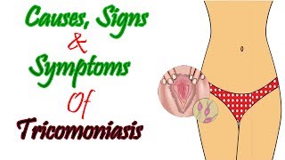 What Do You Understand By Trichomoniasis Causes Signs and Symptoms Of Trichomoniasis [upl. by Osmo]