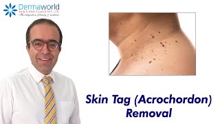 Skin Tag Acrochordon Removal  Dr Rohit Batra [upl. by Yaya823]