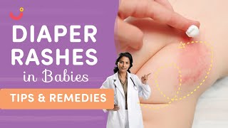 10 Effective Tips for Diaper Rash Treatment  Easy Ways to Prevent Diaper Rash in Babies  Mylo [upl. by Nageek]