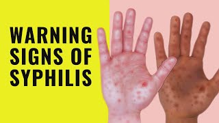 5 Symptoms of Syphilis  Early Signs and symptoms of syphilis  Syphilis [upl. by Yerxa585]