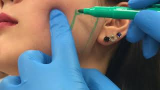 Treating enlarged masseter muscles with Botox by Dr Shaun Patel [upl. by Eniron]