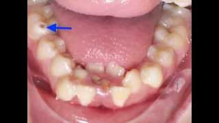 Lower Incisor Extraction Time Lapse Video Kyger Orthodontics [upl. by Adnor]