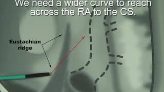 CS Cannulation why the jumbo sheath is important [upl. by Keven776]