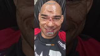 The Worst Injury In UFC History [upl. by Alraep]