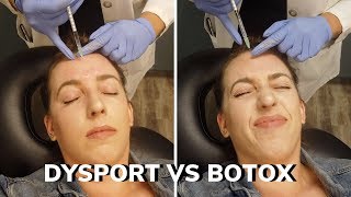 DYSPORT VS BOTOX 💉 CROWS FEET FOREHEAD 11s BEFORE amp AFTER DOES IT WORK PAIN [upl. by Lister]