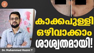 കാക്കപുള്ളി പോവാൻ ശാശ്വത പരിഹാരം  kakkapulli remove malayalam  Dr Razmi [upl. by Airekahs]