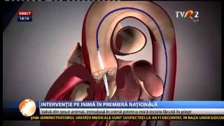 Premieră în România implantare de valvă aortică printro incizie de 5 cm în dreptul inimii [upl. by Jermyn340]