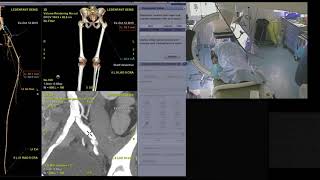 Recanalisation iliaque commune et dilatation iliaque interne en Y [upl. by Euqinmod]