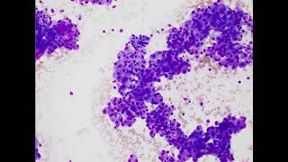 Parotid gland Acinic cell carcinoma Airdried smear [upl. by Burr664]