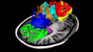 Tractography [upl. by Kathi267]