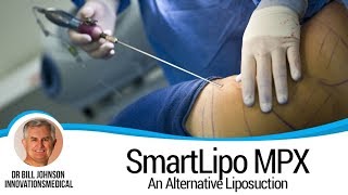 Dr Bill Johnson Features SmartLipo MPX Alternative Liposuction on Fox 4 News [upl. by Durnan]