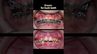 Fix buck teeth with brcaes 36 months braces orthodontist dentist [upl. by Craner]