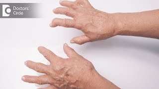 Signs and symptoms of Rheumatoid Arthritis  Dr Prashanth Jain [upl. by Tony]