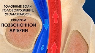 Головные боли головокружение утомляемость  синдром позвоночной артерии [upl. by Kenelm]