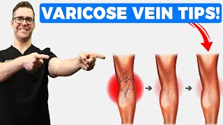 Best Varicose Vein Home Treatments Top 25 Spider Veins Remedies [upl. by Fabozzi]