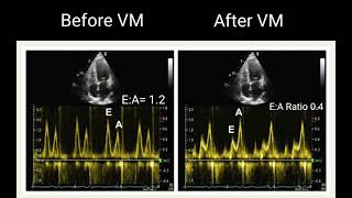 All about LV Diastolic Dysfunction Echocardiography Basics [upl. by Lathrope]