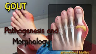 Gout  Pathogenesis and Morphology  Joint pathology emotionalmedico [upl. by Tteirrah965]