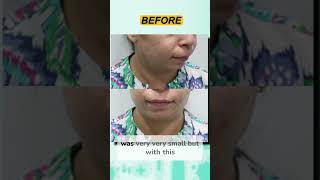 Chin Implants Instant Jawline Upgrade [upl. by Divad962]