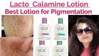 Best Lotions Lacto Calamine for pigmentation pimples 21 days pigmentation Challenge simple diets fa [upl. by Iramohs]