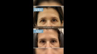 Fine lines go byebye with the help of tamaraspaidern [upl. by Vine]