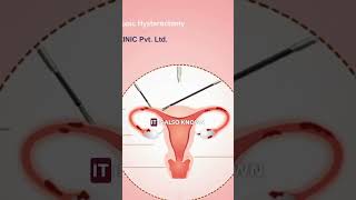 What is laparoscopic surgery drankitachauhan laparoscopicsurgeon surgery hyderabad [upl. by Warenne]