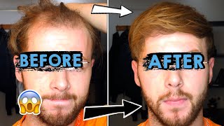 Going bald at 25  How I style my thinning receding hair [upl. by Bary45]