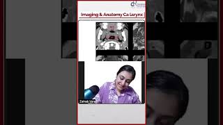 Imaging amp Anatomy of CA Larynx by Dr Zainab Vora  Conceptual Radiology [upl. by Atinar650]