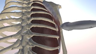 3D Model of an Ultrasound Guided Injection of the Scapulothoracic Infraserratus Bursa [upl. by Lucine]