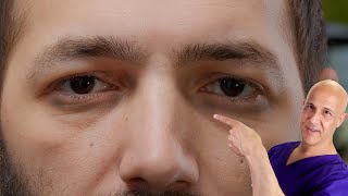 1 Vitamin to Remove Dark Circles  Dr Mandell [upl. by Tlevesor]