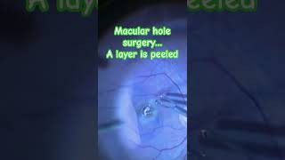 Macular hole surgery [upl. by Ayatnwahs]