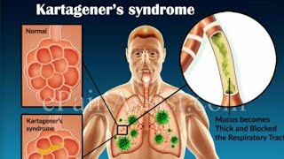 Kartagener syndrome trick  ENT important question [upl. by Adin]