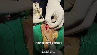 Rhinoplasty surgery cosmeticsurgery confidenceboost rhinoplasty rhinoplastybeforeandafter yts [upl. by Bainbridge]