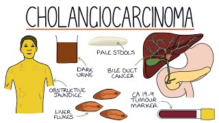 Understanding Cholangiocarcinoma [upl. by Leiram675]