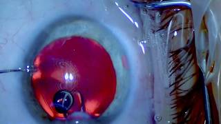 ICL Explantation  Senile Cataract  Nanolaser  Drmed AmirMobarez Parasta  MUNICH EYE [upl. by Fitts]