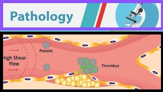 42 Thrombosis [upl. by Heinrike]