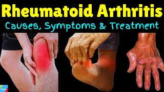 Rheumatoid Arthritis – Signs amp Symptoms Causes Diagnosis Treatment Complications [upl. by Baxie589]