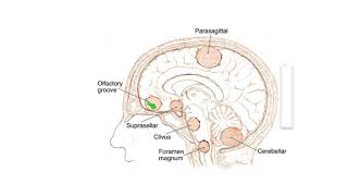 Meningiomas Signs Symptoms and Advanced Treatment Options [upl. by Nap759]