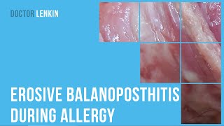 💣 Erosive balanoposthitis during allergy [upl. by Longawa527]