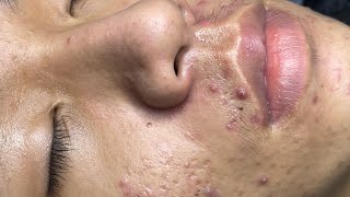 ACNE TREATMENT VU QUYNH MI Acne On Boys Cheek 2024 [upl. by Graves75]