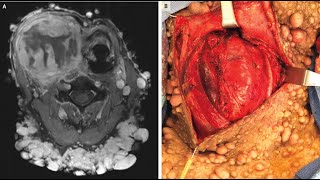 Maligner peripherer Nervenscheidentumor bei Neurofibromatose Typ 1 [upl. by Eixam359]